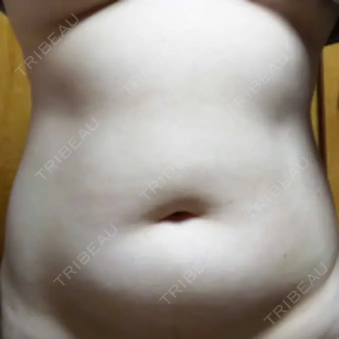 脂肪冷却（お腹） Dual Clinic SHINSAIBASHI DAY 22 メイン用