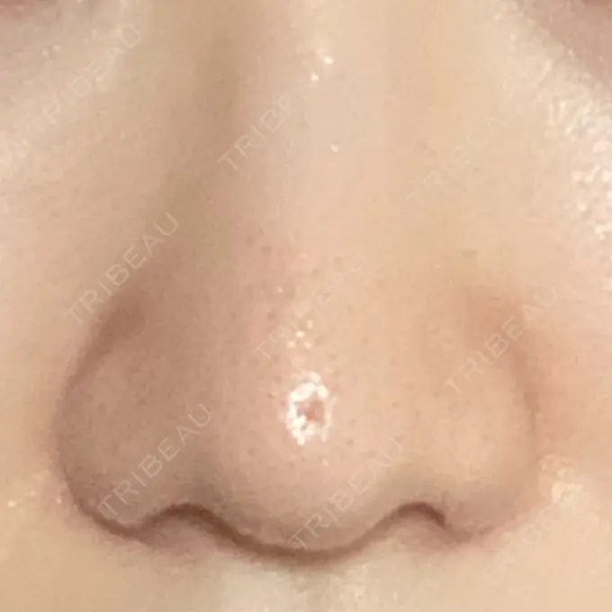 小鼻縮小（切開） 三輪皮フ科形成外科 DAY 91 メイン用