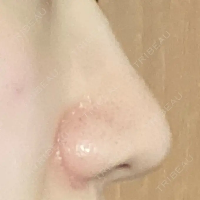 小鼻縮小（切開） 三輪皮フ科形成外科 DAY 91 メイン用