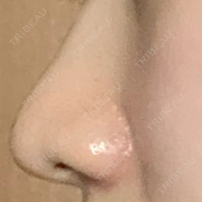 小鼻縮小（切開） 三輪皮フ科形成外科 DAY 91 メイン用