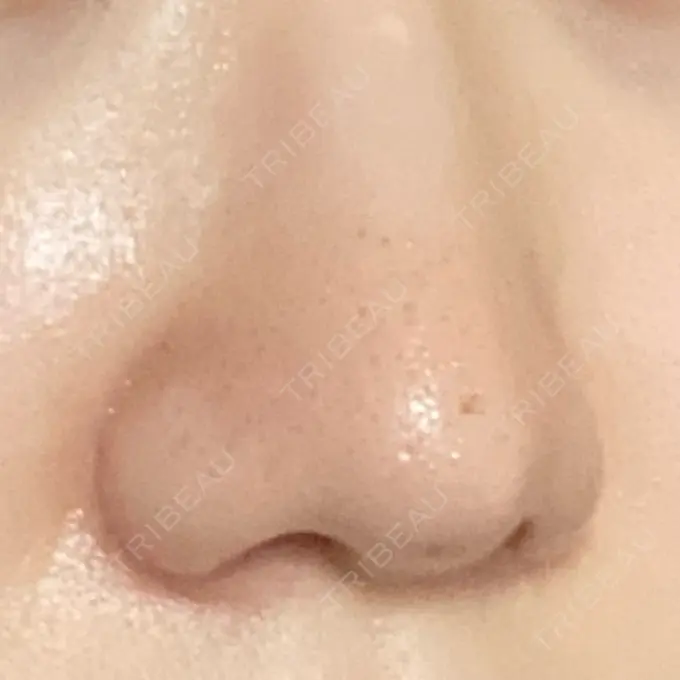 小鼻縮小（切開） 三輪皮フ科形成外科 DAY 91 メイン用