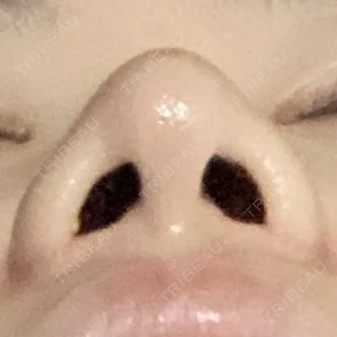 小鼻縮小（切開） 三輪皮フ科形成外科 DAY 91 メイン用