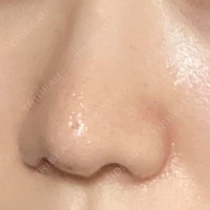 小鼻縮小（切開） 三輪皮フ科形成外科 DAY 91 メイン用