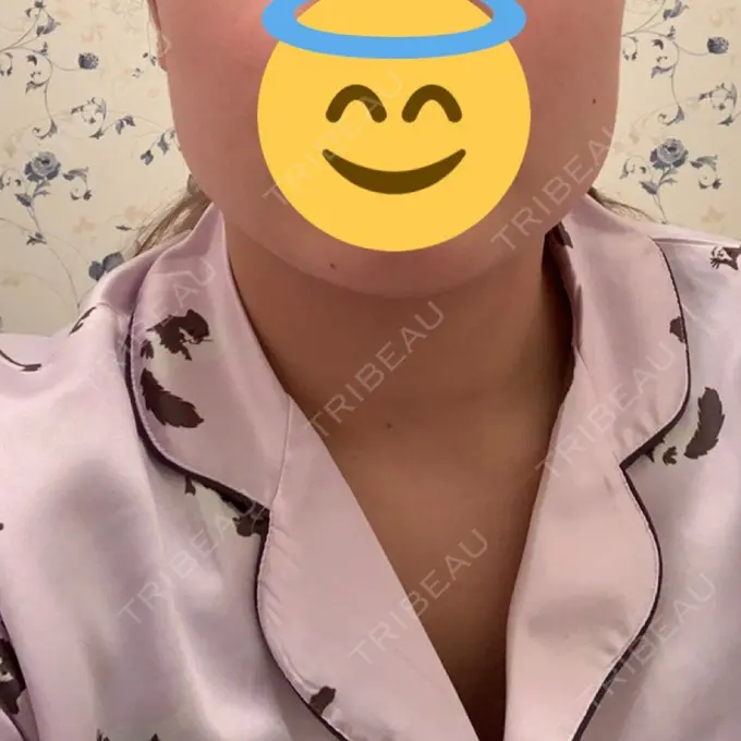 ボトックス（あご） / ボトックス（エラ・小顔） 湘南美容クリニック 名古屋栄院 DAY 13 メイン用