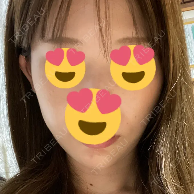 糸リフト / ヒアルロン酸注入（あご） ノーチェビューティクリニック DAY 15 メイン用