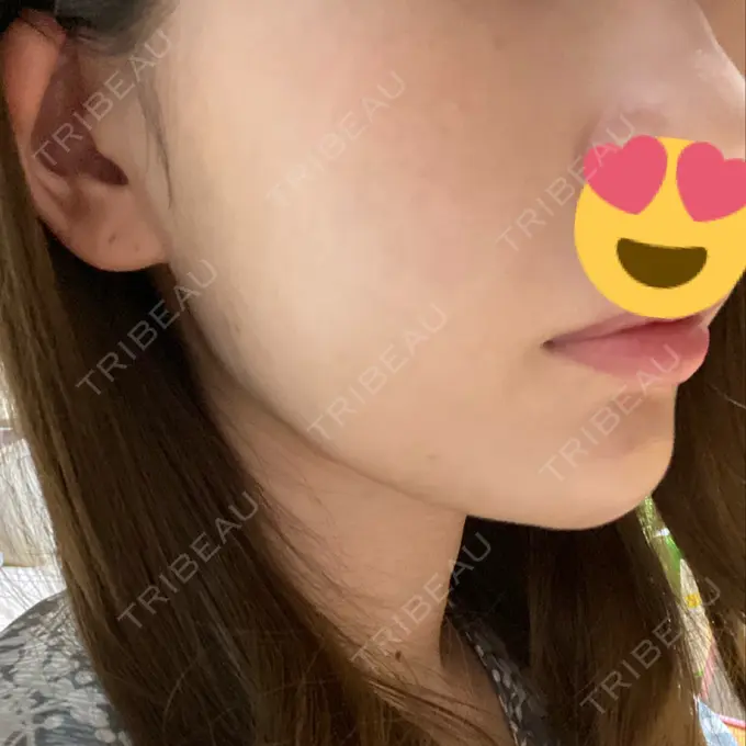 糸リフト / ヒアルロン酸注入（あご） ノーチェビューティクリニック DAY 15 メイン用