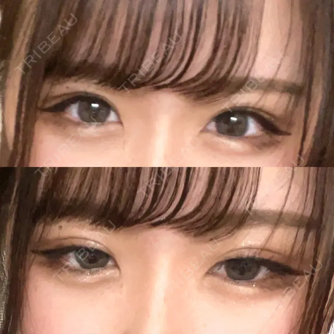 二重埋没 / ヒアルロン酸注入（涙袋） ルラ美容クリニック 新宿院 DAY 176 メイン用