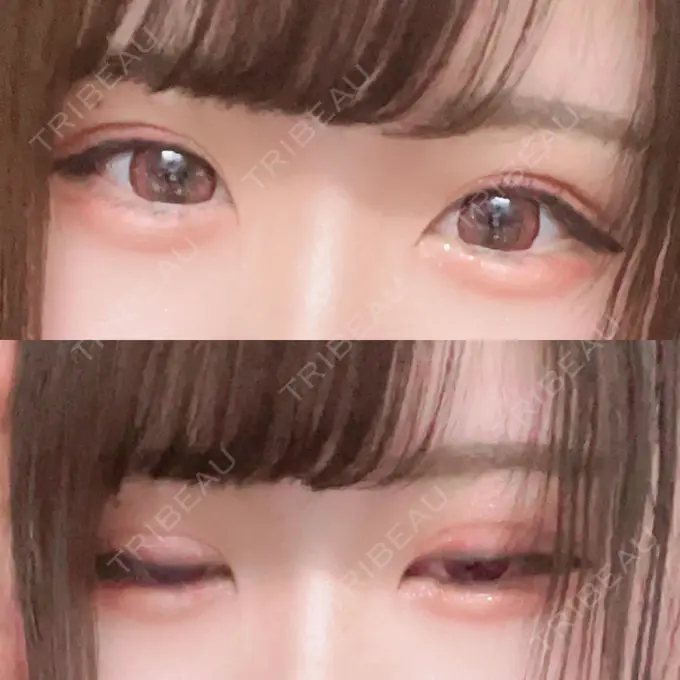 二重埋没 / ヒアルロン酸注入（涙袋） ルラ美容クリニック 新宿院 AFTER メイン用