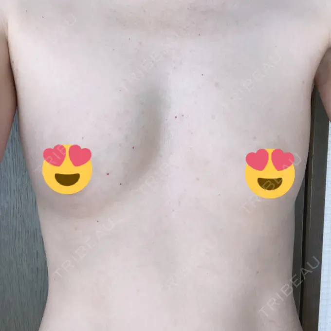 脂肪吸引（脚） / 豊胸（脂肪注入） THE CLINIC（ザ・クリニック） 名古屋院 AFTER メイン用