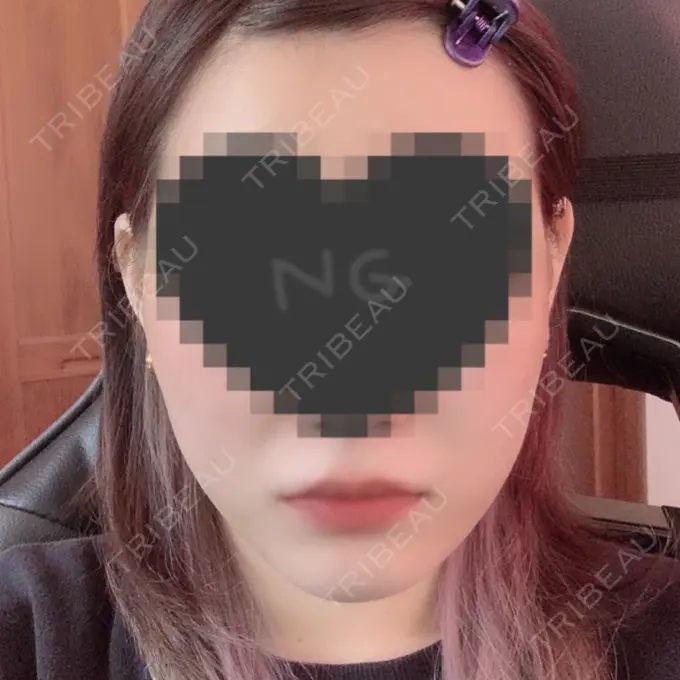 ボトックス（エラ・小顔） / その他（輪郭） 東京形成美容外科 船橋院 DAY 8 メイン用