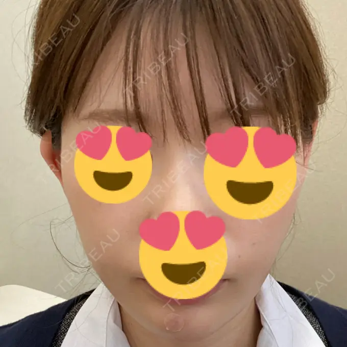 糸リフト / ヒアルロン酸注入（あご） ノーチェビューティクリニック DAY 17 メイン用