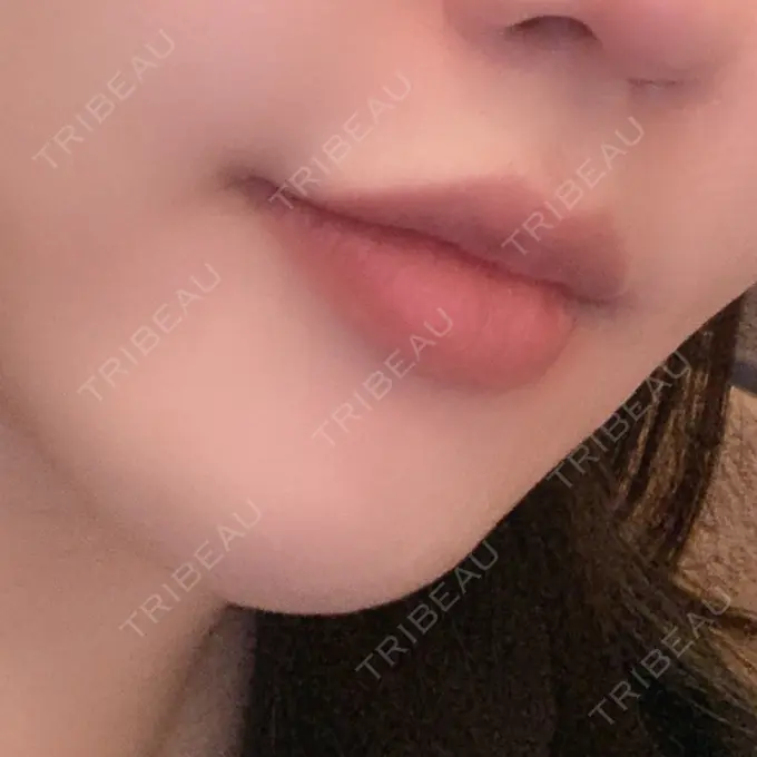 口角挙上 eクリニック 金沢本院 DAY 63 メイン用