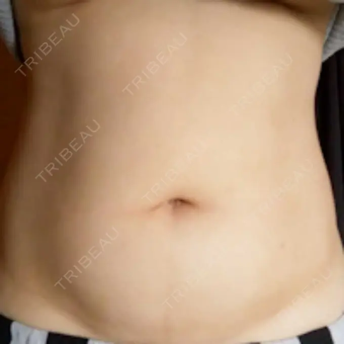 脂肪冷却（お腹） Dual Clinic SHINSAIBASHI DAY 29 メイン用