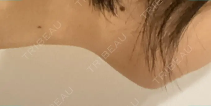 脂肪溶解注射（顔） TCB東京中央美容外科 横浜院 DAY 5 メイン用