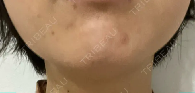 脂肪溶解注射（顔） TCB東京中央美容外科 横浜院 DAY 5 メイン用