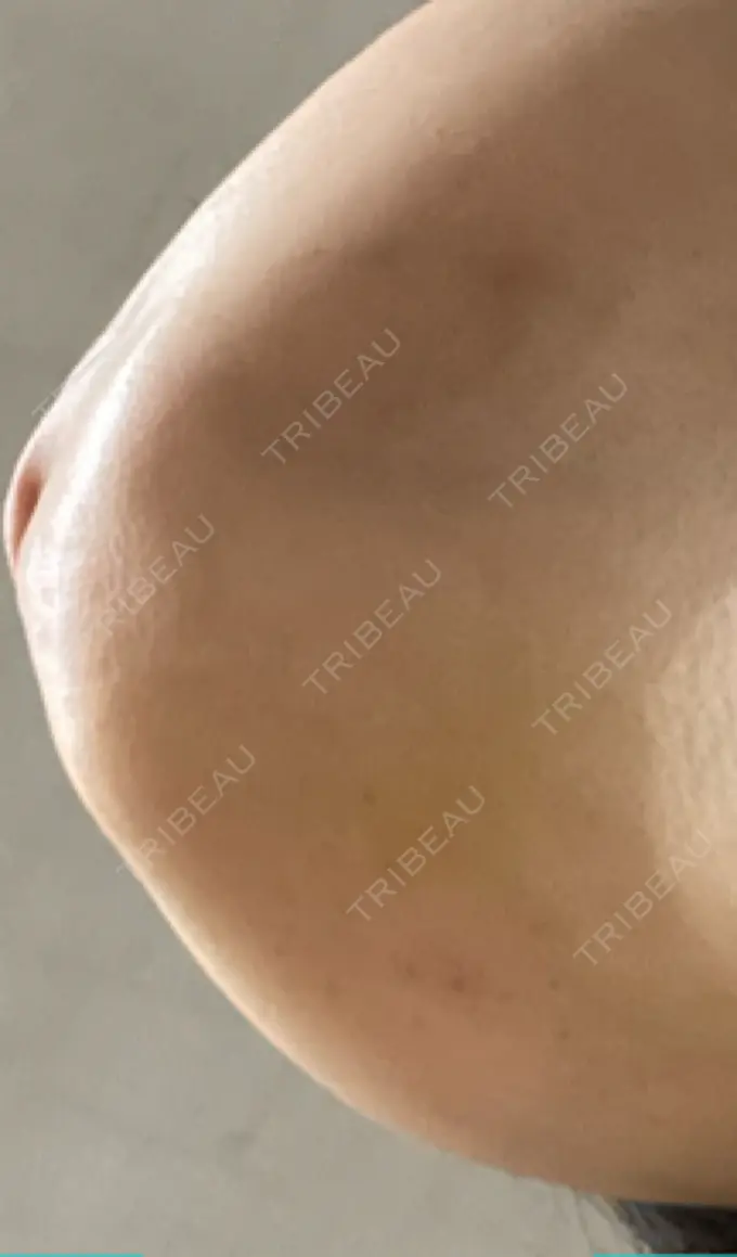 脂肪溶解注射（顔） TCB東京中央美容外科 横浜院 DAY 5 メイン用