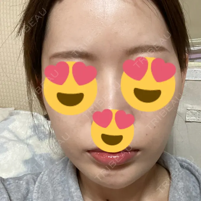 糸リフト / ヒアルロン酸注入（あご） ノーチェビューティクリニック AFTER メイン用