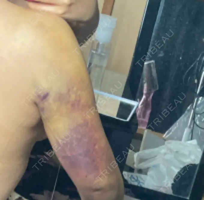 脂肪吸引（二の腕） 湘南美容クリニック 新潟院 DAY 7 メイン用