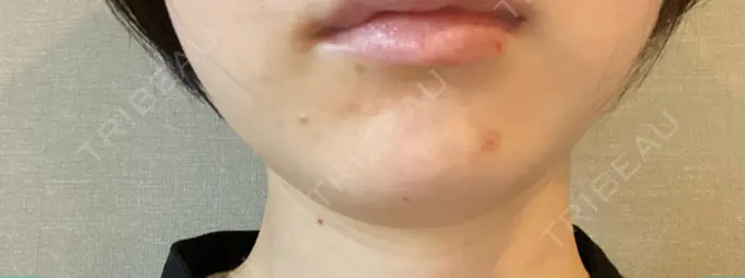 脂肪溶解注射（顔） TCB東京中央美容外科 横浜院 AFTER メイン用