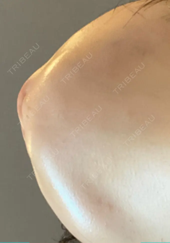 脂肪溶解注射（顔） TCB東京中央美容外科 横浜院 DAY 6 メイン用