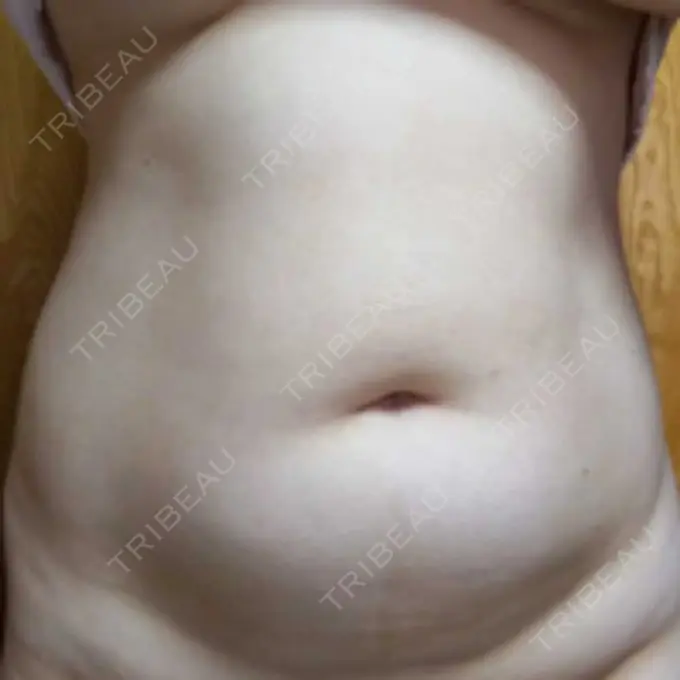 脂肪冷却（お腹） Dual Clinic SHINSAIBASHI DAY 31 メイン用