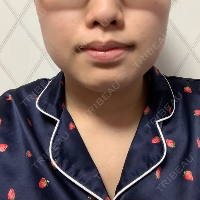 ボトックス（あご） / ボトックス（エラ・小顔） 湘南美容クリニック 名古屋栄院 DAY 19 メイン用