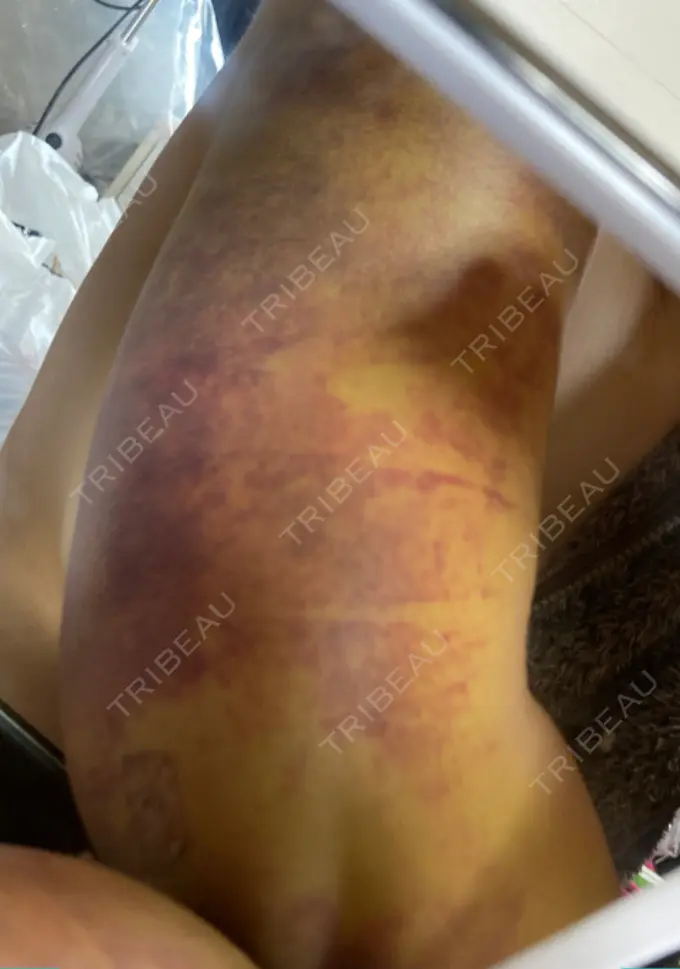 脂肪吸引（二の腕） 湘南美容クリニック 新潟院 DAY 8 メイン用