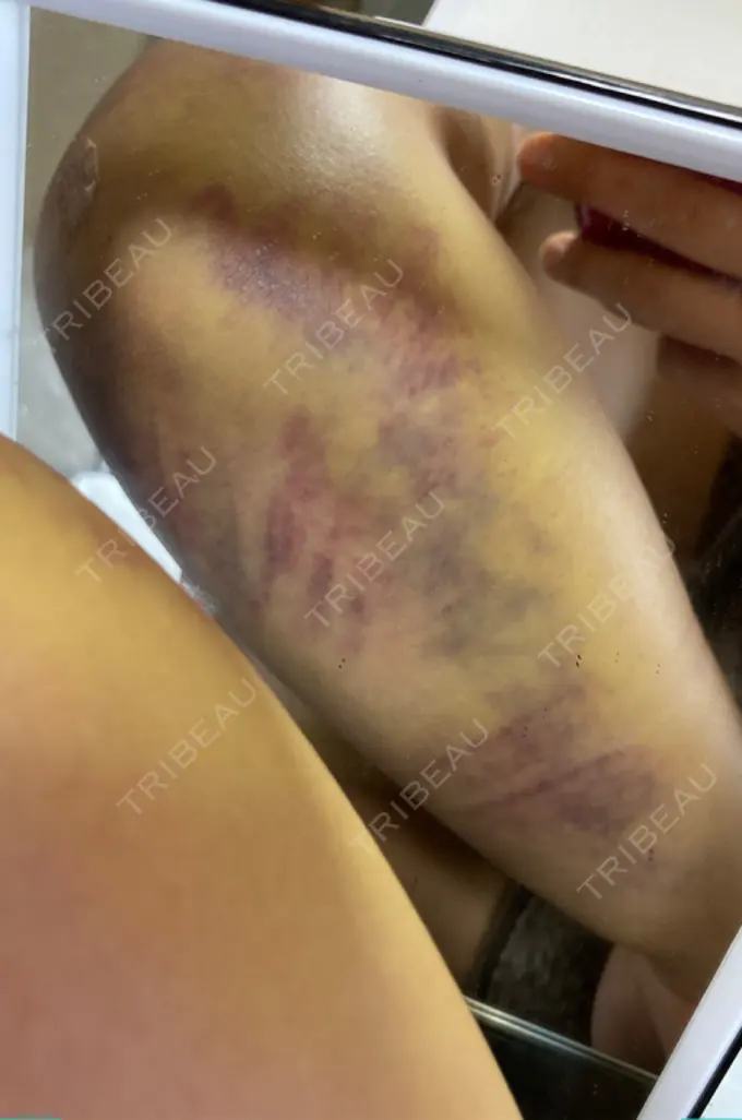 脂肪吸引（二の腕） 湘南美容クリニック 新潟院 DAY 8 メイン用