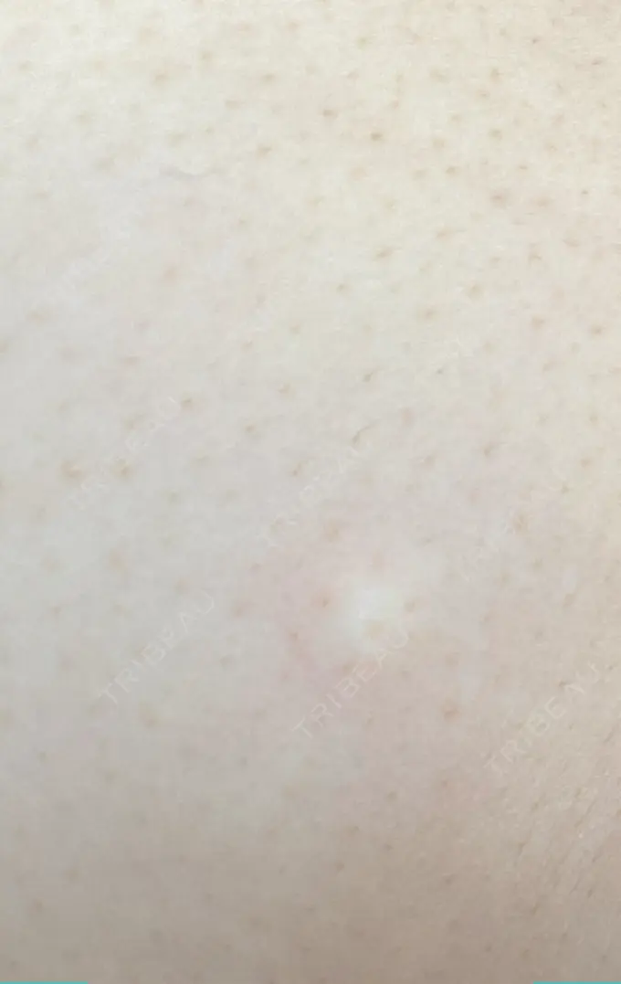 GLP-1ダイエット 湘南美容クリニック 横須賀中央院 DAY 8 メイン用