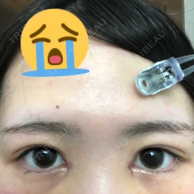 二重埋没 / 二重切開 / 矯正（ワイヤー） 湘南美容クリニック 橋本院 DAY 9 メイン用