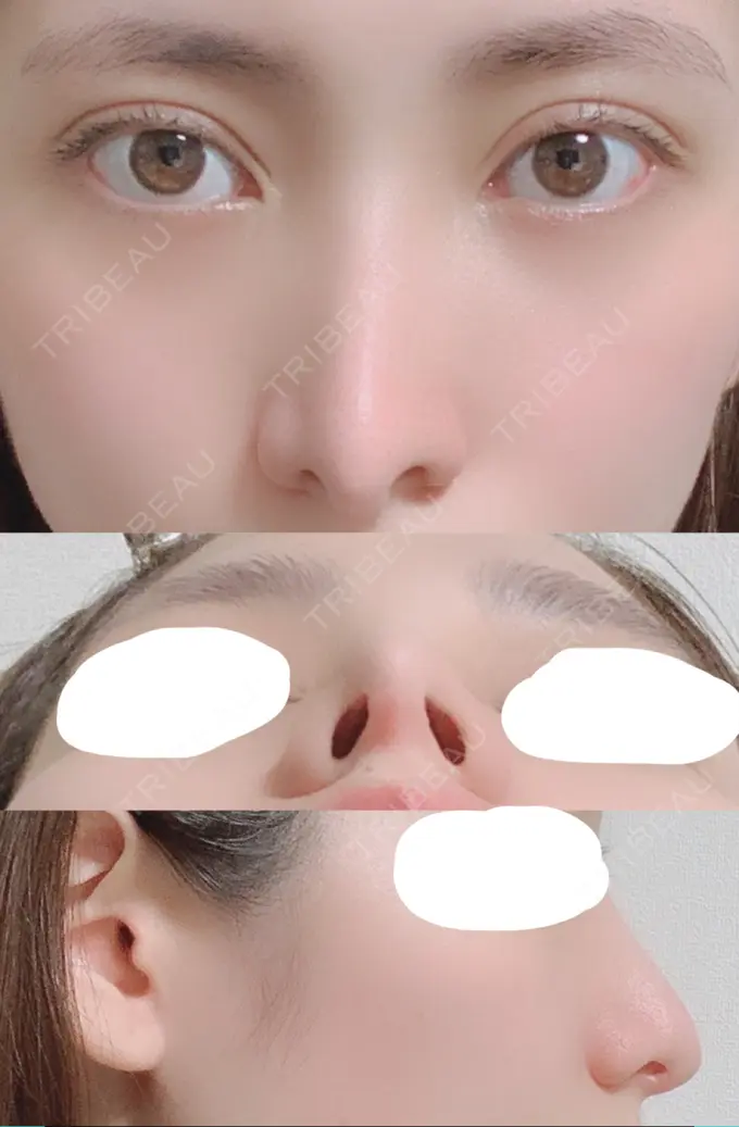 鼻尖形成（切開） / 鼻中隔延長（切開） / 骨切幅寄せ / 鼻修正 湘南美容クリニック 新橋銀座口院 DAY 135 メイン用