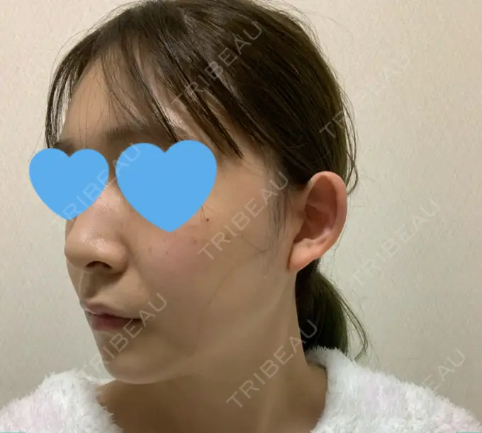 骨切り（あご） / 骨削り（エラ） / 骨削り（頬） / 脂肪吸引（顔） アーククリニック DAY 58 メイン用