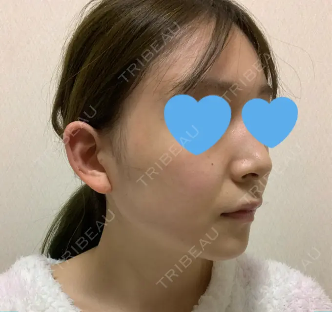 骨切り（あご） / 骨削り（エラ） / 骨削り（頬） / 脂肪吸引（顔） アーククリニック DAY 58 メイン用