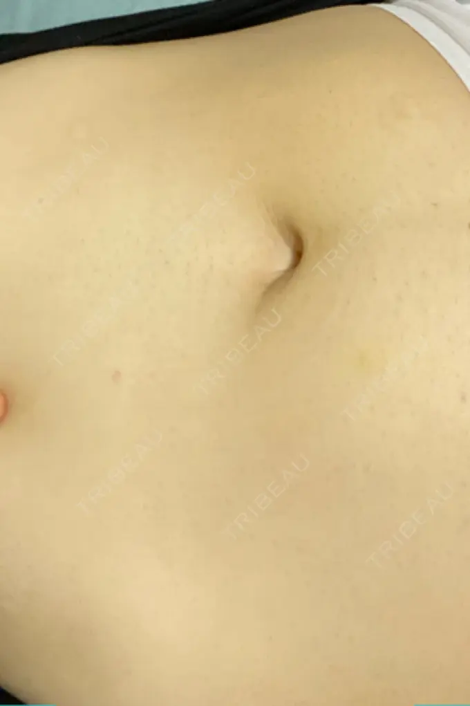 GLP-1ダイエット 湘南美容クリニック 横須賀中央院 DAY 9 メイン用