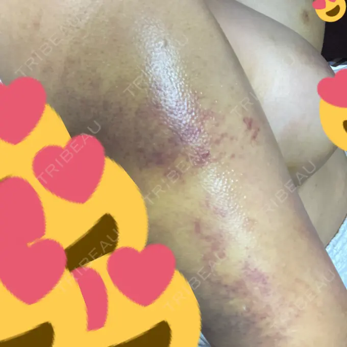 脂肪吸引（二の腕） 湘南美容クリニック 新潟院 DAY 10 メイン用