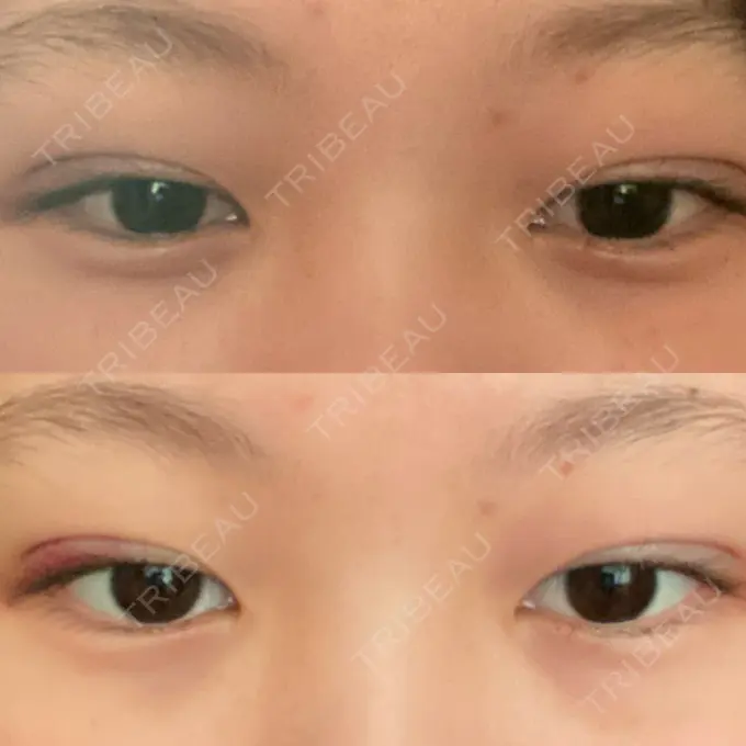 二重埋没 ラミュー広島中央クリニック DAY 1 メイン用