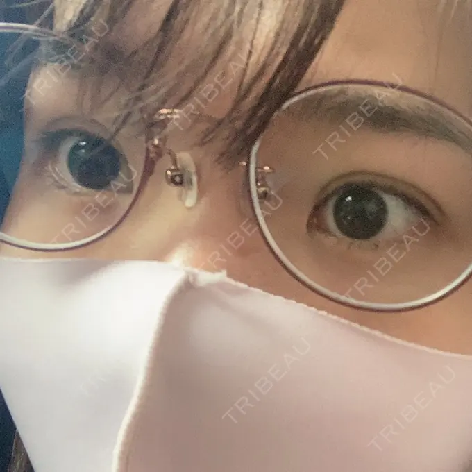 二重埋没 湘南メディカル記念病院（両国） DAY 0 メイン用