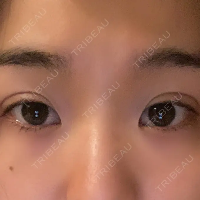 二重埋没 湘南メディカル記念病院（両国） DAY 0 メイン用