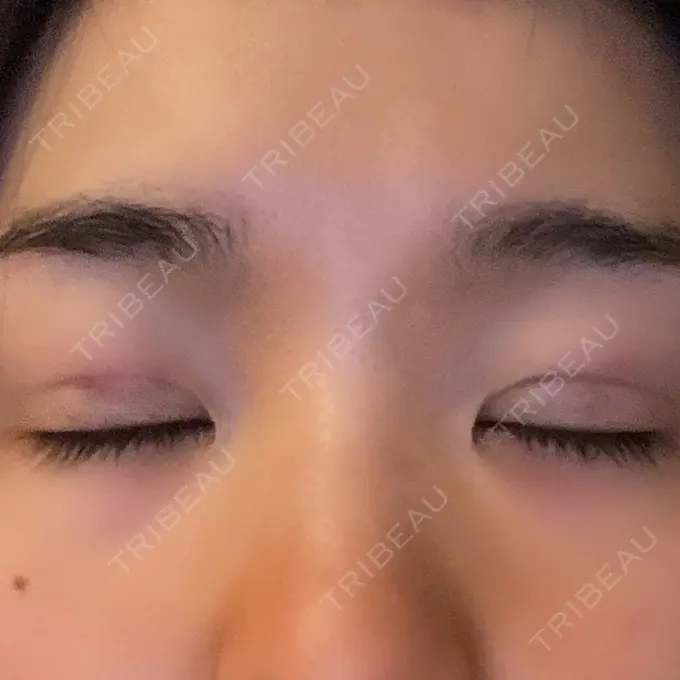 二重埋没 湘南メディカル記念病院（両国） DAY 0 メイン用