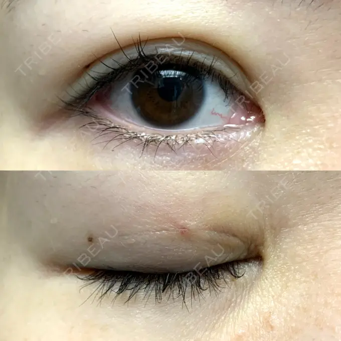 二重埋没 / 目元修正 札幌ル・トロワ ビューティクリニックVogue DAY 3 メイン用