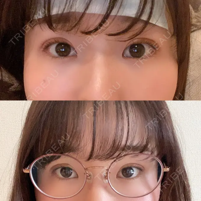 二重埋没 湘南メディカル記念病院（両国） DAY 1 メイン用