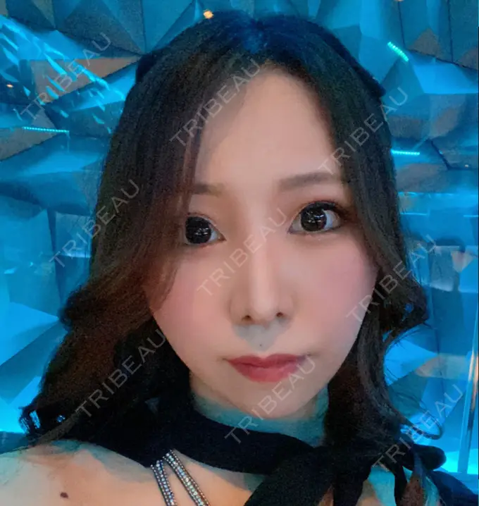 鼻尖形成（切開） / 鼻中隔延長（切開） / 軟骨移植 / 鼻孔縁下降 / その他（鼻） 湘南美容クリニック 新宿本院 AFTER メイン用