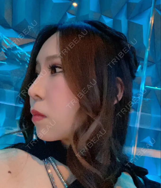 鼻尖形成（切開） / 鼻中隔延長（切開） / 軟骨移植 / 鼻孔縁下降 / その他（鼻） 湘南美容クリニック 新宿本院 DAY 300 メイン用