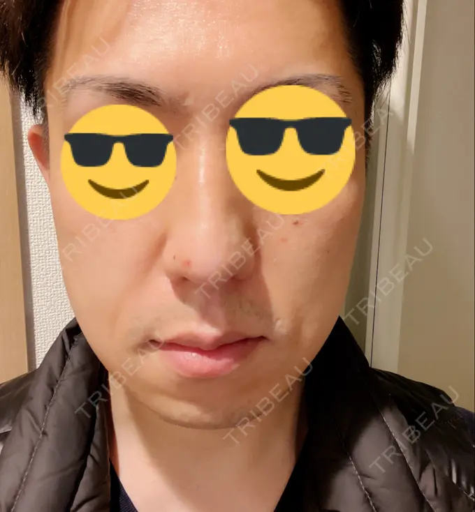 骨切り（あご） / 骨削り（エラ） 心斎橋コムロ美容外科クリニック AFTER メイン用