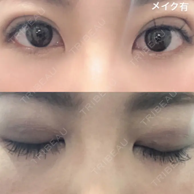 二重埋没 MIL CLINIC OSAKA DAY 2 メイン用