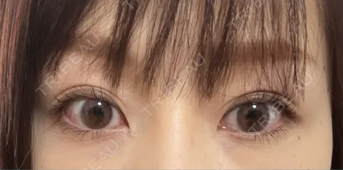 二重埋没 湘南美容クリニック 福島院 AFTER メイン用