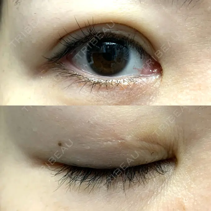 二重埋没 / 目元修正 札幌ル・トロワ ビューティクリニックVogue DAY 4 メイン用