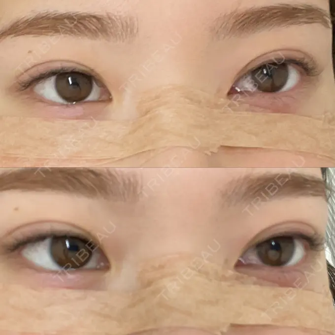 下まぶたの脂肪取り 城本クリニック 福岡院 DAY 0 メイン用