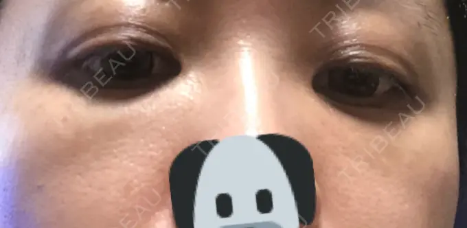 クマ治療 / 下まぶたたるみ取り / 下まぶたの脂肪取り 湘南美容クリニック 橋本院 DAY 39 メイン用