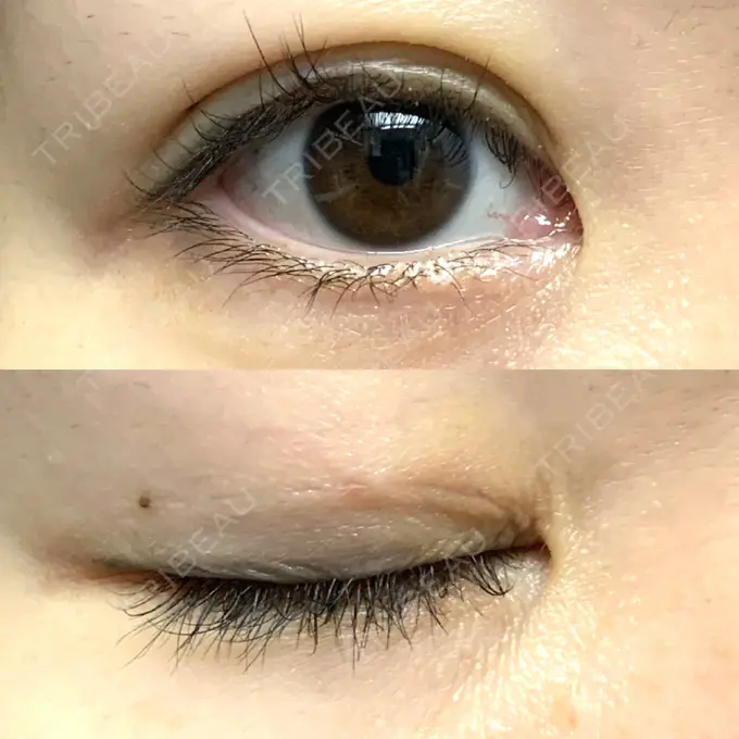 二重埋没 / 目元修正 札幌ル・トロワ ビューティクリニックVogue DAY 4 メイン用